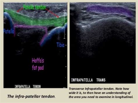 Presentation Pptx Radiological Anatomy Of The Knee Joint Ppt