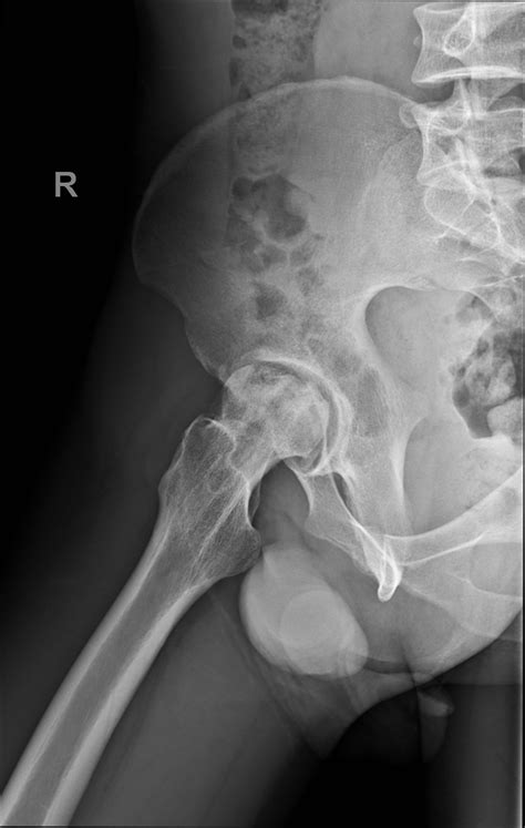 Avascular Necrosis Hip Joints Image