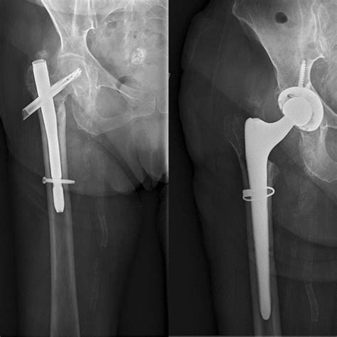 Conversion total hip arthroplasty following extracapsular hip fracture ...