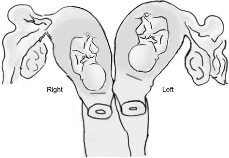 Double Uterus Causes Symptoms Complications