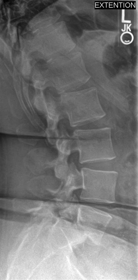 Spondylolisthesis L S X Ray