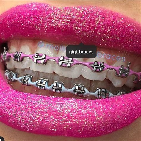 Pin By Bruce Nicolosi On Power Chain Braces Colors Teeth Braces