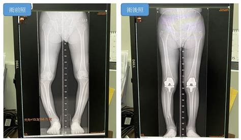 7旬阿北骨折後遺症下肢變形 雙膝矯正成功擺脫多年o型腿 Enn台灣電報