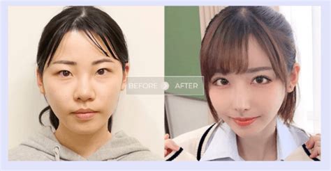 Japanese Plastic Surgery Before After