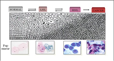 New Biomarkers For Cervical Cancer Perspectives From The IGF System