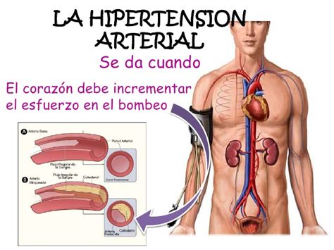 Biofisica Riesgos De La Hipertension Arterial