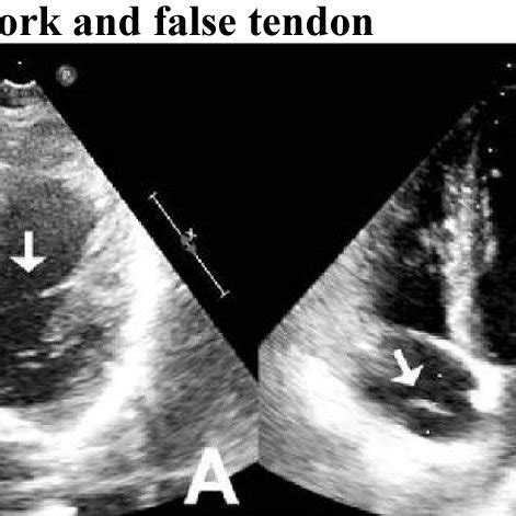 A Modified Apical Four Chamber Transthoracic Echocardiographic View