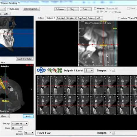 Volume Rendered Cbct Images For The Airway In Either Color Enhanced