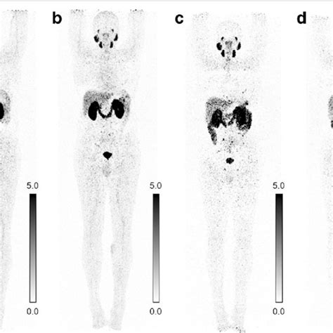 Comparison Of PET CT Scans Obtained With 152 Tb PSMA 617 And 68