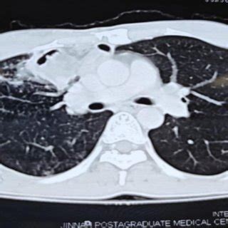 Anterior Chest Wall Abscess With Discharging Sinus And Osteomyelitis Of