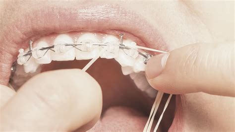 Qu Son Y Para Qu Sirven Las Gomas De Los Brackets Cl Nica Dental