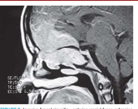 Figure 3 From Intracranial Extension Of Fungal Sinusitis Semantic Scholar