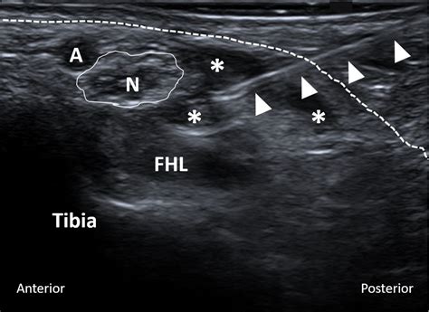 Ultrasoundguided Injection Technique For Ulnar Tunnel