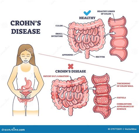 Crohns Disease As Inflammatory Bowel Problem Explanation Outline