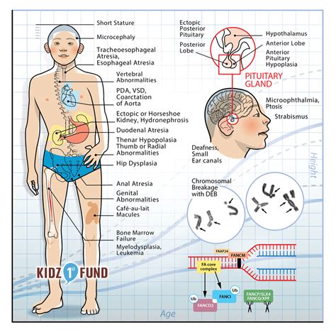 Fanconi Anemia Illustration By Marty Harris Medical Illustration And Animation