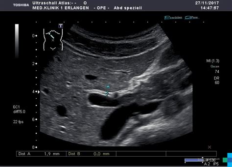 Normal Common Bile Duct Ultrasound