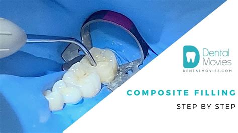 Composite Filling Step By Step Youtube