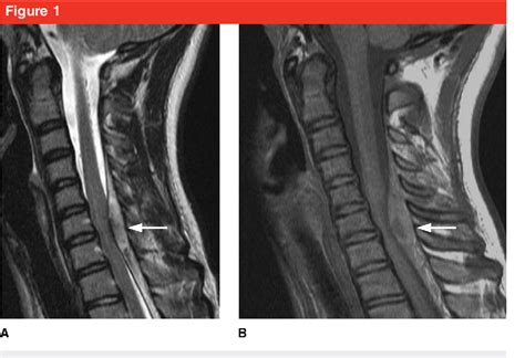 Figure 1 From Spinal Epidural Hematoma Semantic Scholar