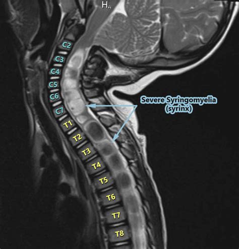 From The Inside Out Understanding Syringomyelia And Syringobulbia Chiari Bridges