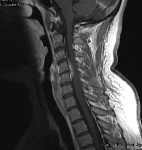 T1 Weighted Sagittal Magnetic Resonance Imaging With Contrast Of The Download Scientific