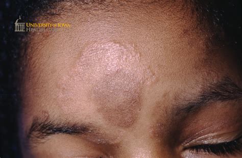 Edematous Annular Pink To Hyperpigmented Plaque On The Forehead And