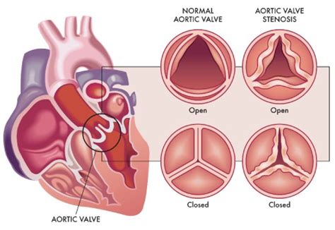 Treatment of Aortic Stenosis - TAVR, TAVI, SAVR | Dr Raghu