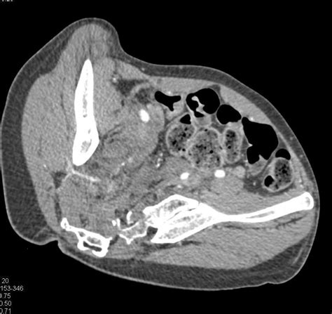 Complex Sacral Fracture With Hematoma And Pelvic Ring Fractures Involving The Symphysis