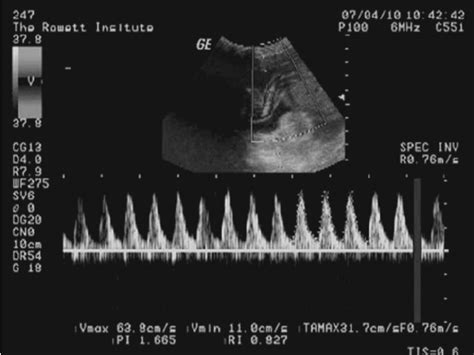 Umbilical Artery Doppler Waveform Sonogram Demonstrating The Download Scientific Diagram