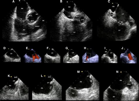 Use Of Intracardiac Echocardiography In Interventional Cardiology