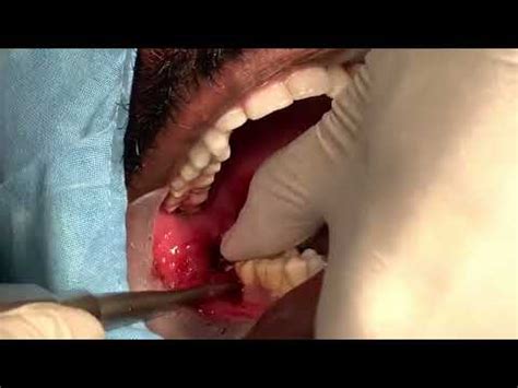 Wisdom Tooth Extraction YouTube