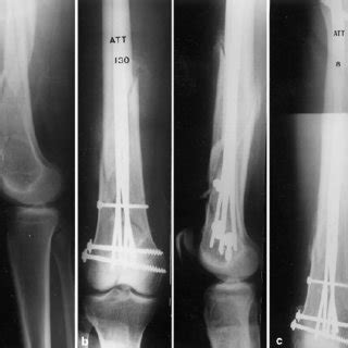 A C A Year Old Woman Sustained Fractures Of Both Femoral Shafts