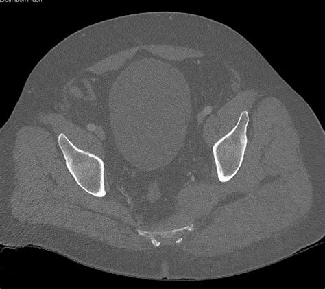 Gluteal Hematoma