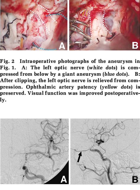 Postoperative Left Carotid Angiograms Anteroposterior View A And