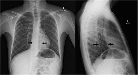 Presentation of an H-type tracheoesophageal fistula in an adolescent male with cystic fibrosis ...