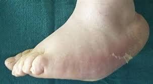 Charcot Deformity