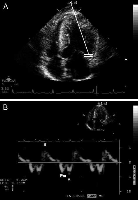 Doppler Tissue Imaging Dti Echocardiography Echo Of A Maine Coon