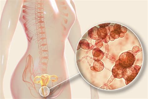 Ataque De Nervios Sobrevivir Mayoria Candida Albicans Sintomas Y Tratamiento Cívico Viuda Labio