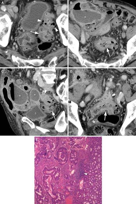 Atypical Perforated Adenocarcinoma In The Sigmoid Colon Of A Download Scientific Diagram