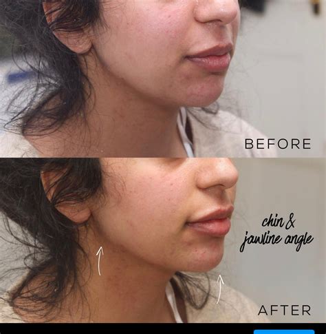 Jaw Filler Before And After Photos And Results