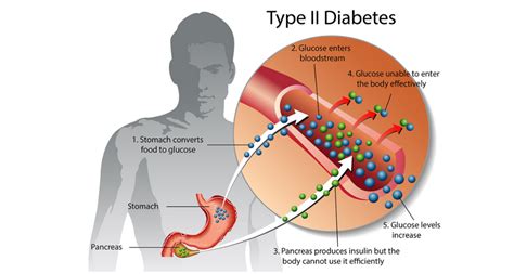 Type 2 Diabetes Mellitus Diagram