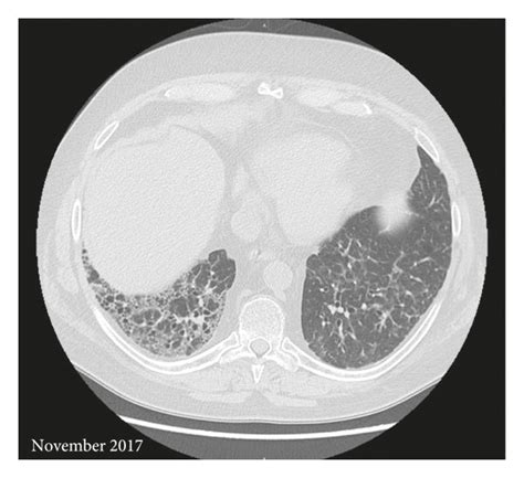 Chest High Resolution Computed Tomography November 2017 Compared To