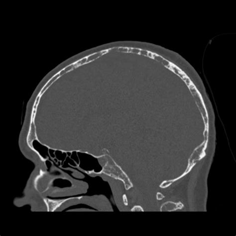 Multiple Myeloma Raindrop Skull Image