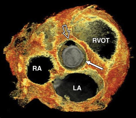 The Role Of Ecg Gated Mdct In The Evaluation Of Aortic And Mitral