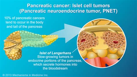 Pancreatic Cancer Pathophysiology Diagnosis And Staging