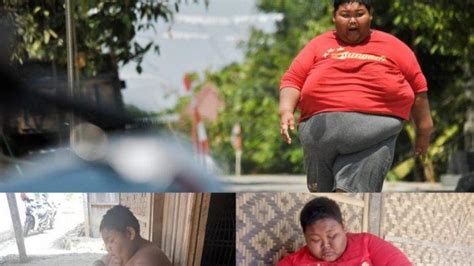 Foto Foto Sungadi Pemuda Obesitas Berbobot 140 Kilogram Yang Viral Dari