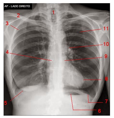 Radiologia Na Web Radiografia De T Rax Ap Ntero Posterior E