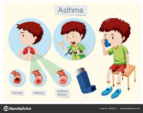 Human Anatomy Health Asthma Illustration Stock Vector Image By