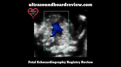 Normal Fetal Echocardiogram YouTube