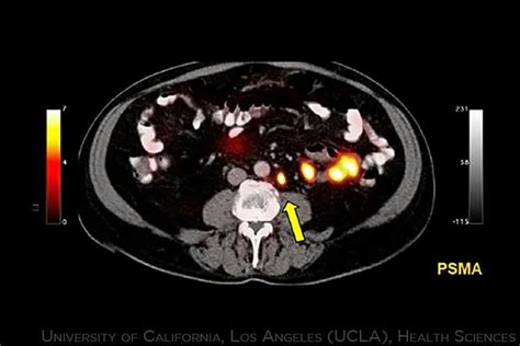 PSMA PET CT Better Detects Prostate Cancer Spread MedPage Today