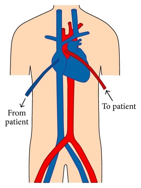 Illustrations Of Various Va Ecmo Cannulations Diagram A Depicts A